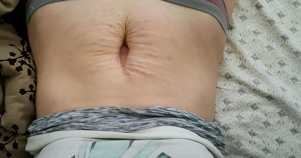 rectus diastase